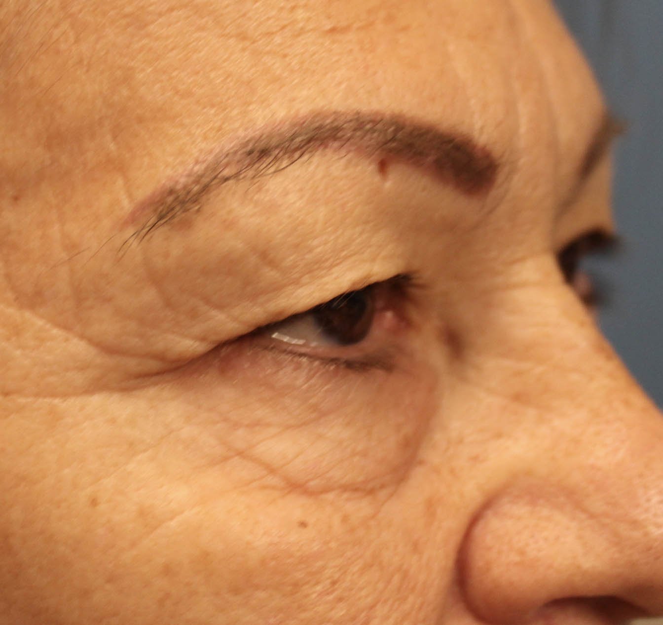 left eye 70 year old female before blepharoplasty surgery