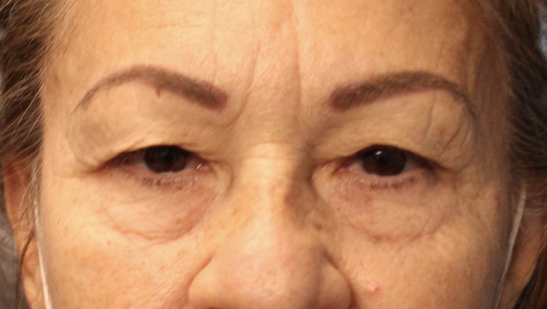 front facing 70 year old woman upper blepharoplasty before