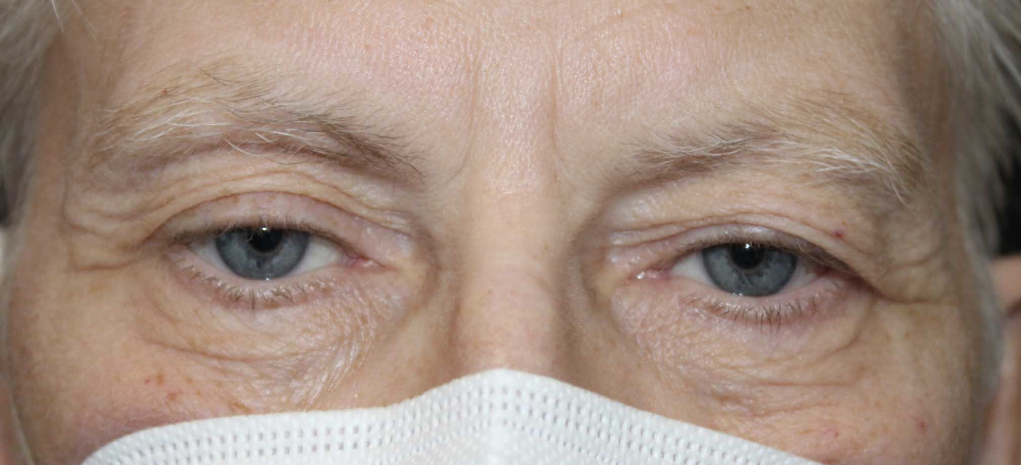 before surgical procedure on 70 year old male with ptosis