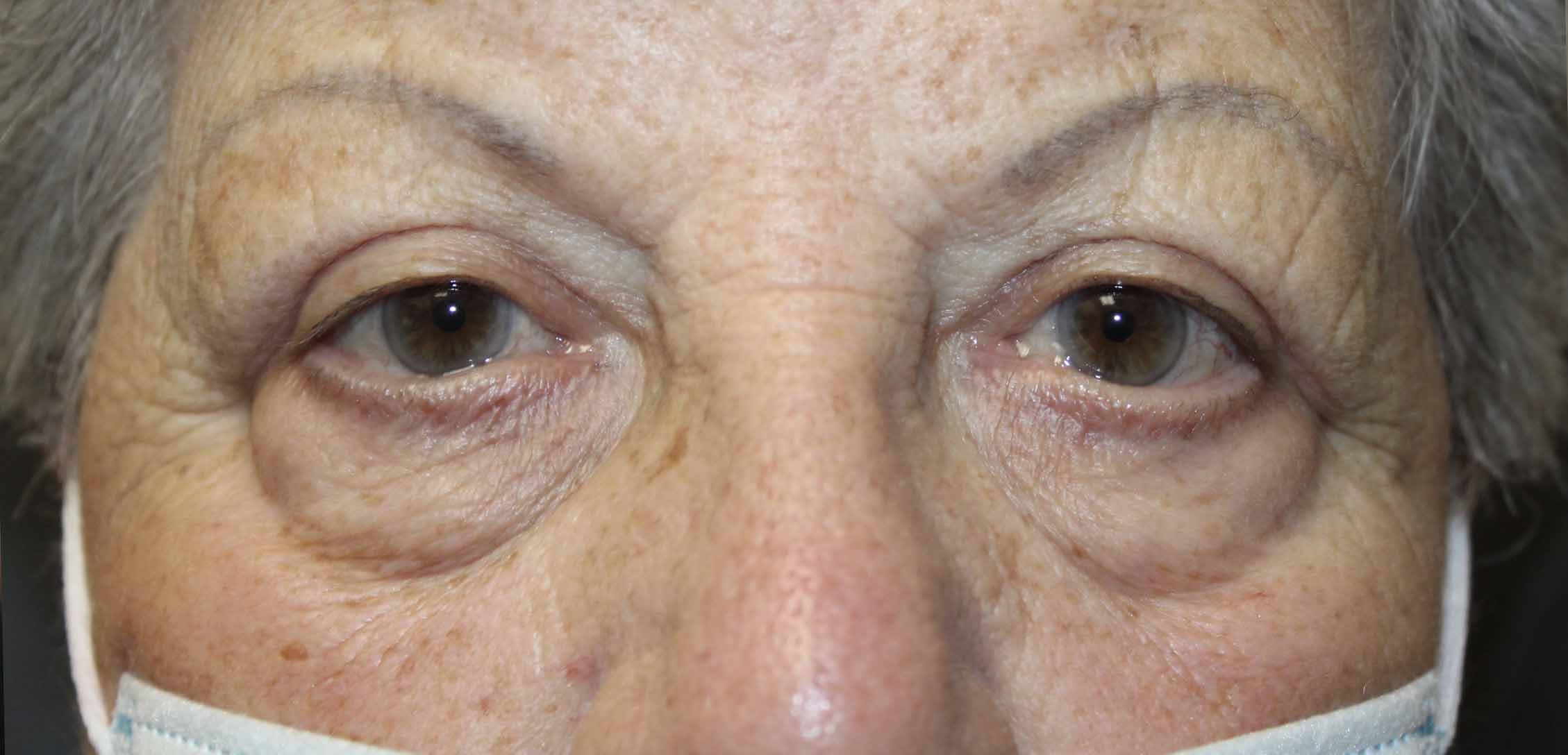 70 year old woman 2 months after blepharoplasty procedure
