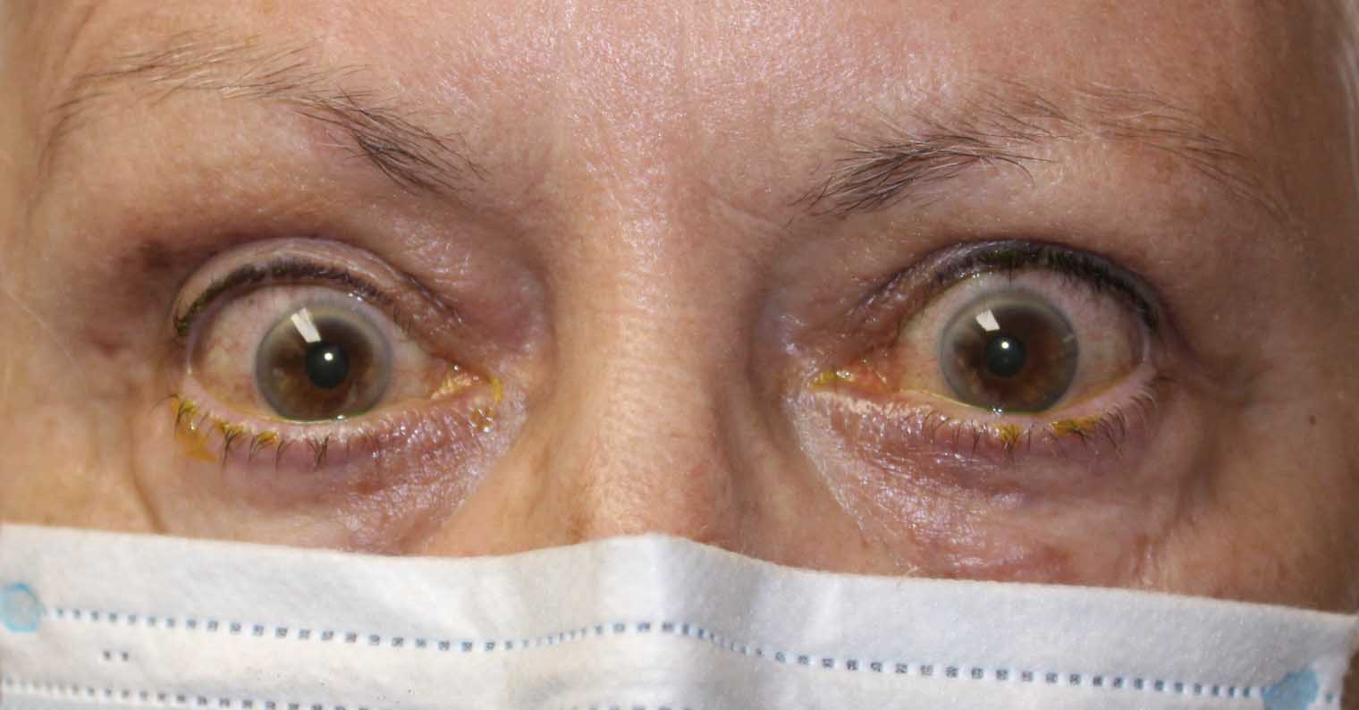 womans eyes after receiving thryoid eye disease repair treatment