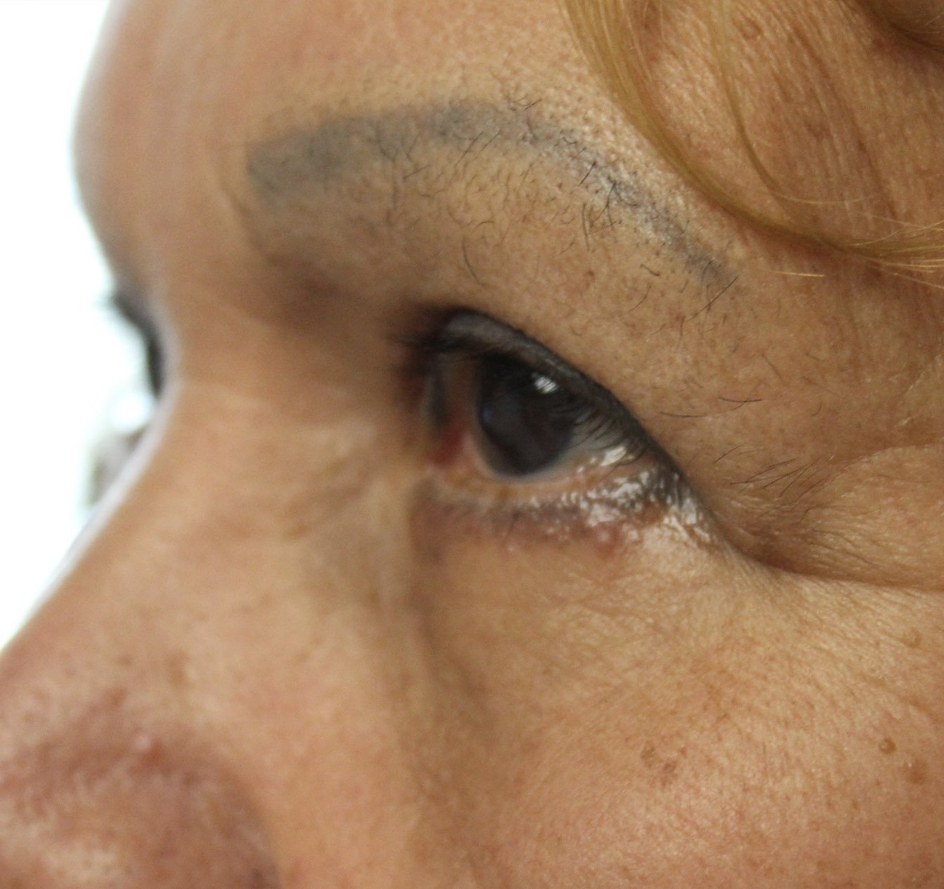 side angle of 71 year old woman after blepharoplasty procedure