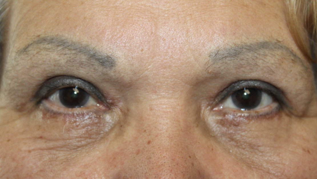 71 year old woman upper and lower blepharoplasty results