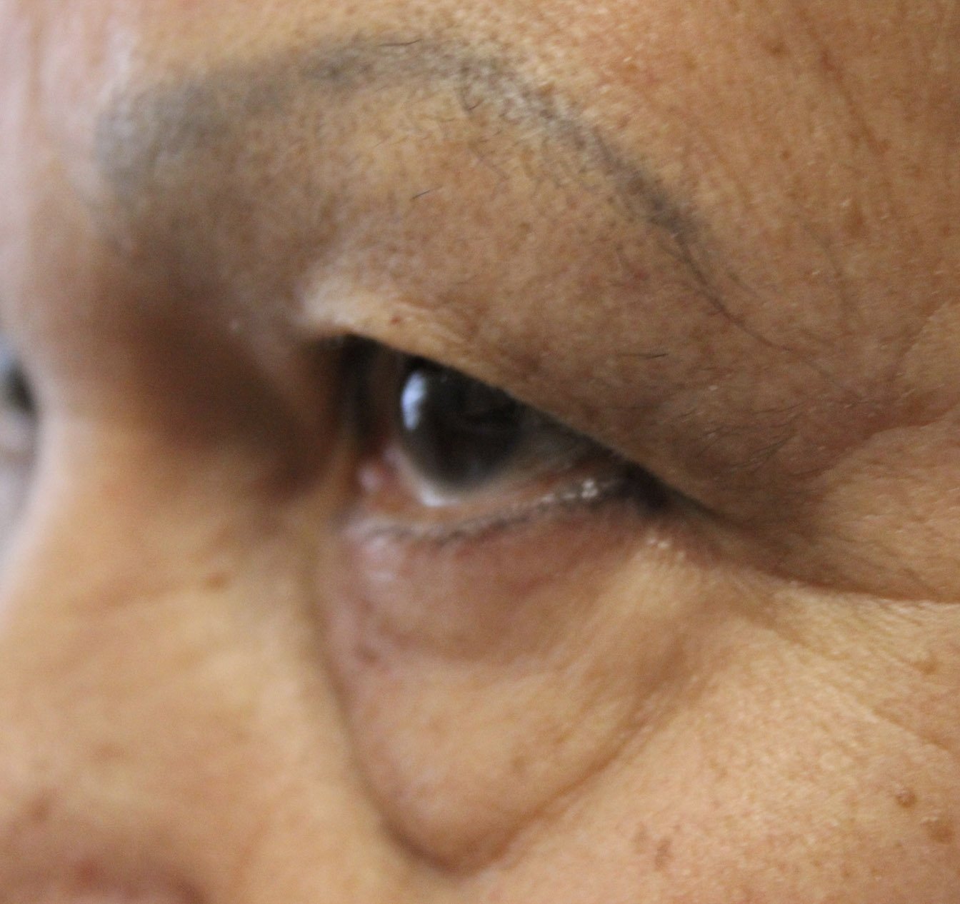 71 year old woman side angle before blepharoplasty procedure
