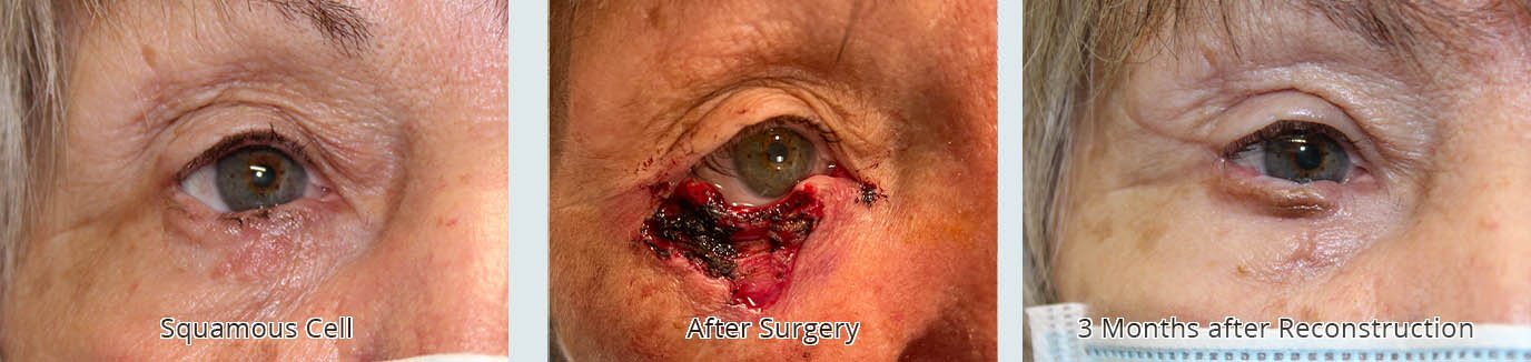 75 year old female before and after squamous cell removal