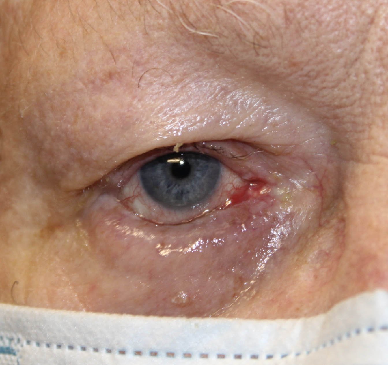 75 year old man after receiving entropion eye repair surgery