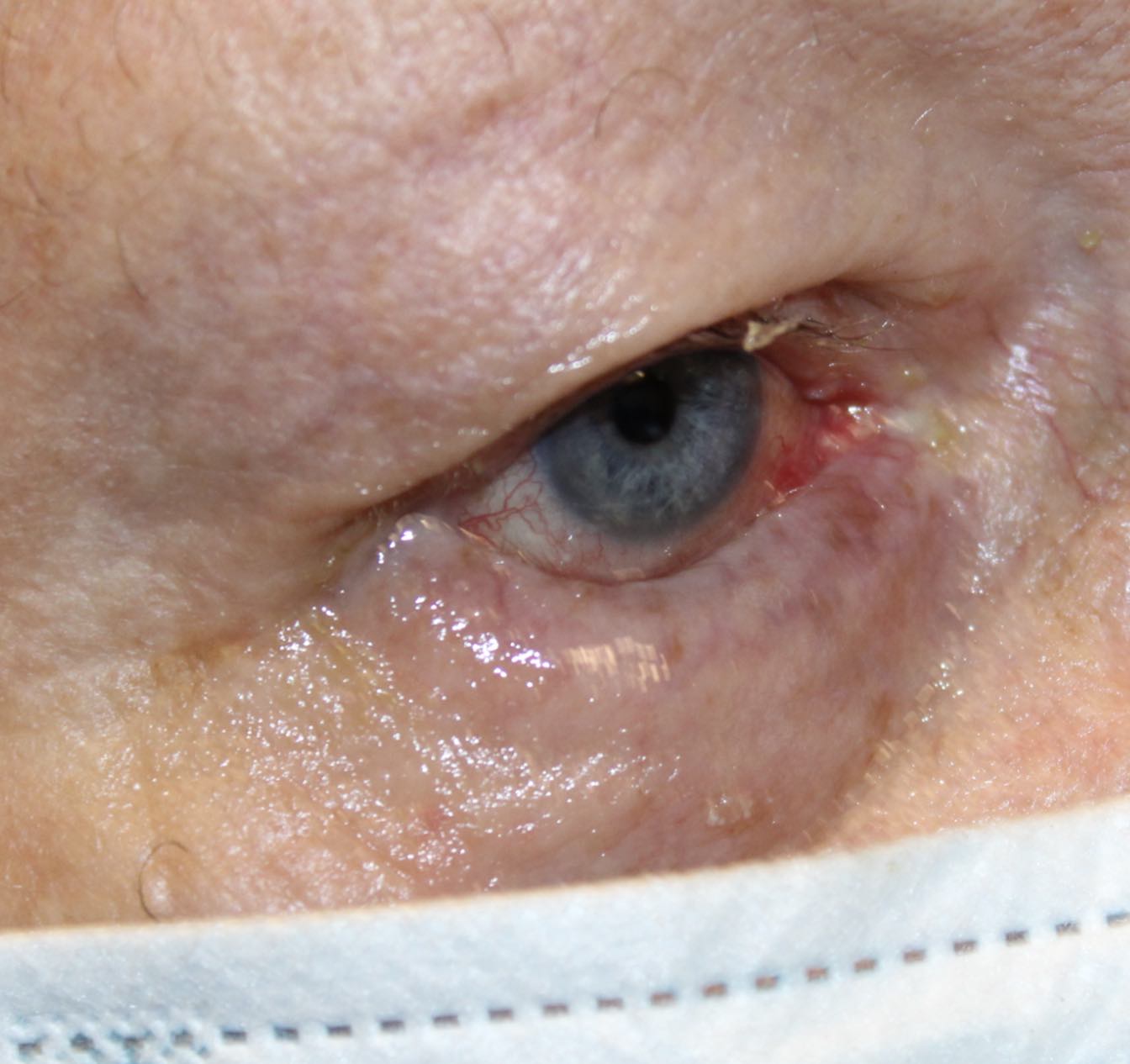 75 year old male after entropion eye repair