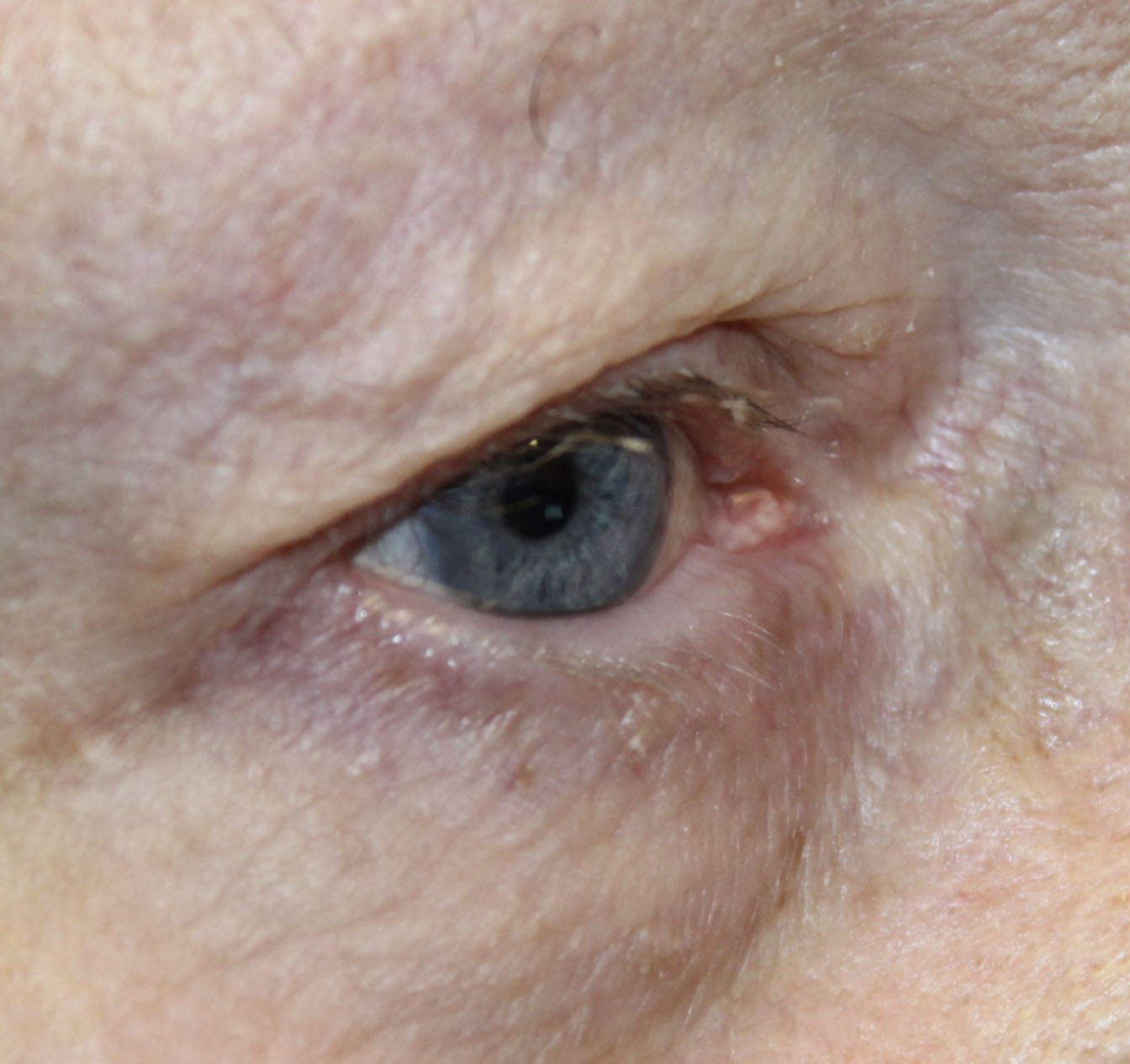 75 year old main before receiving entropion eye repair