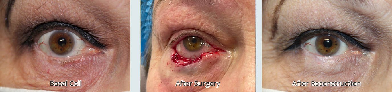 basal cell removal before, during, and after reconstructive surgery results