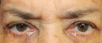 80 year old male after blepharoplasty procedure