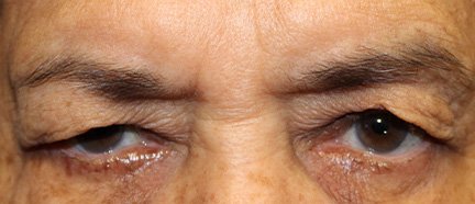 80 year old male before upper blepharoplasty surgery