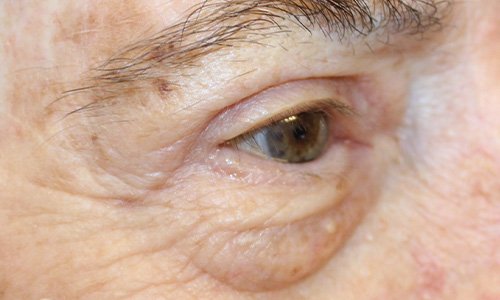 80 year old after upper blepharoplasty eye surgery results