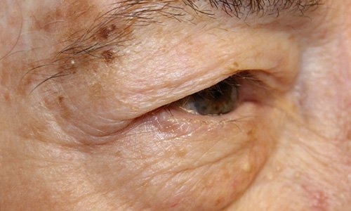 80 year old before upper eyelid blepharoplasty surgery procedure