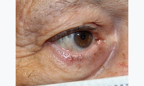 80 year old man after receiving entropion eyelid repair