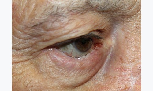 80 year old male patient before entropion eye surgery