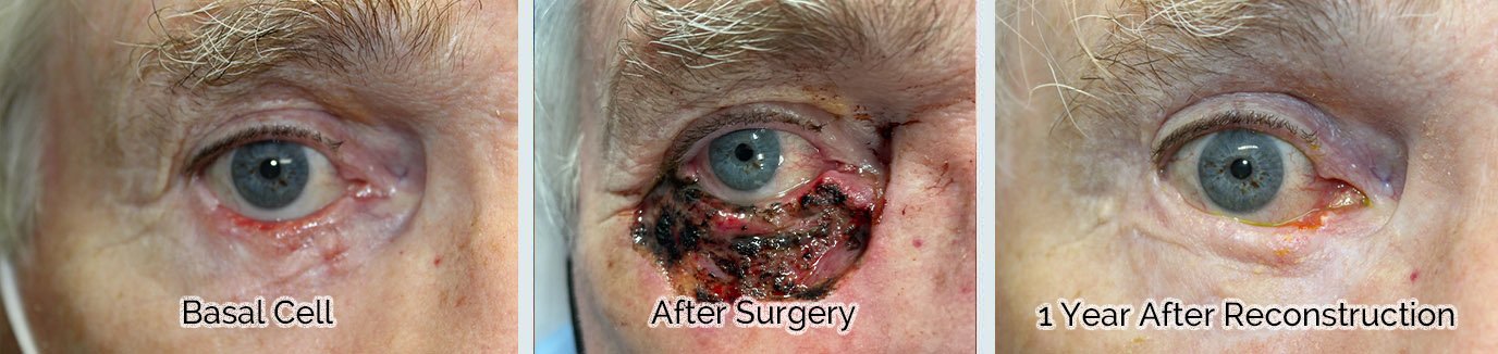 removal of basal cell on 80 year old male patient before, during, and after