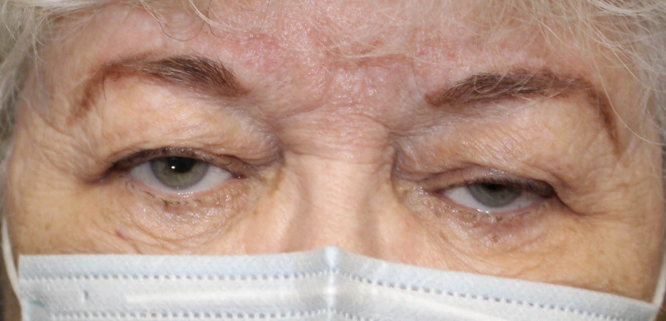 81 year old female before ptosis repair surgical procedure