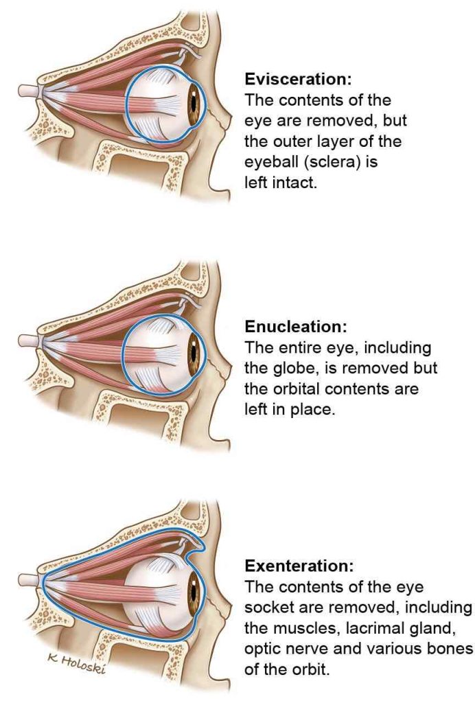 different types of eye removal