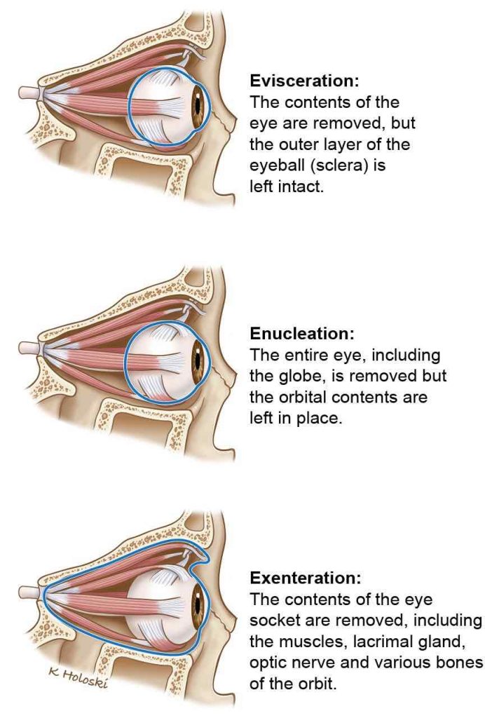 different types of eye removal 