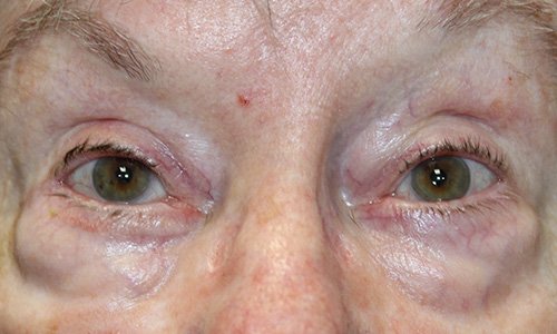 84 year old woman skin graft results around the eye