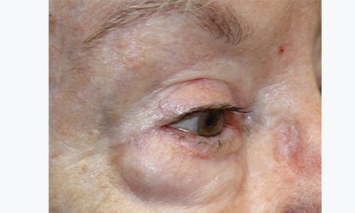84 year old female patient after skin graft procedure around the eye