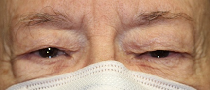 before the procedure of 90 year old upper blepharoplasty
