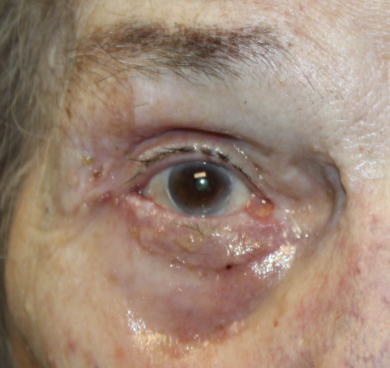 91 year old woman ectropion eye repair surgery example
