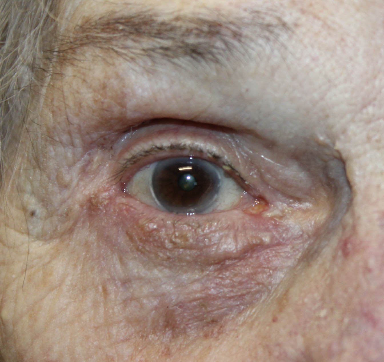 91 year old woman skin graft surgical repair