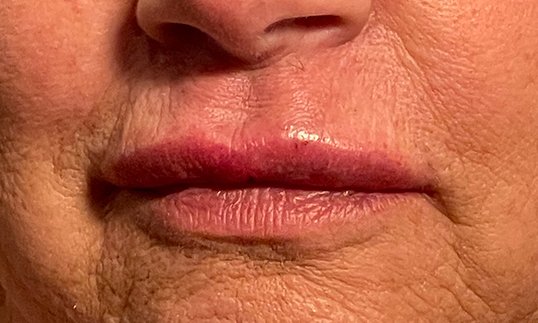 female lips immediately after restylane injections
