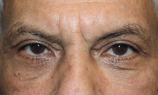 results of blepharoplasty on male patient