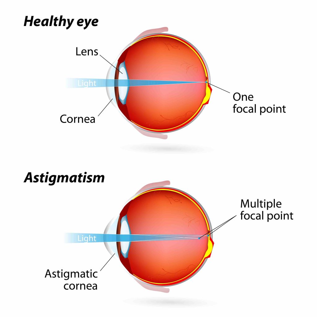 Diagram showing how an eye with astigmatism absorbs light compared to a healthy eye