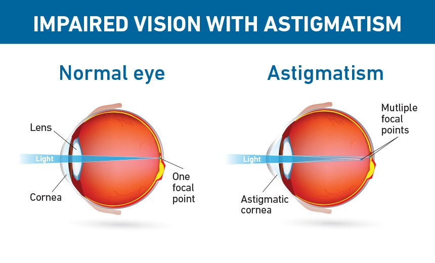 Diagram comparing the light refraction of a normal eye and an eye with astigmatism