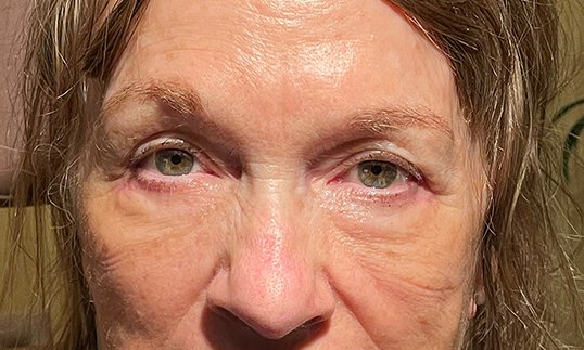middle aged woman after receiving blepharoplasty surgery looking straight ahead