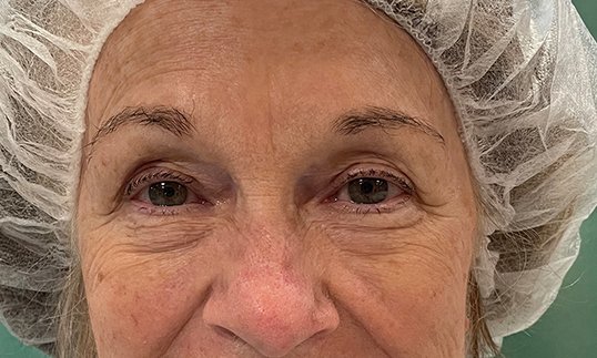 before blepharoplasty surgery on female patient