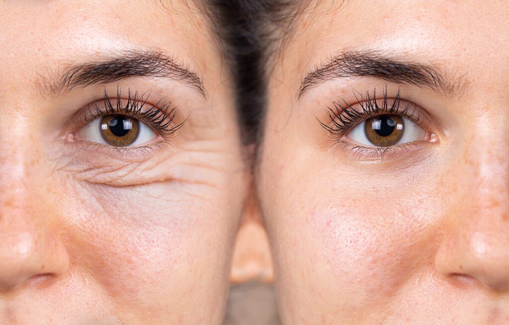 Side by side of a girl before and after eye surgery. You see less wrinkles