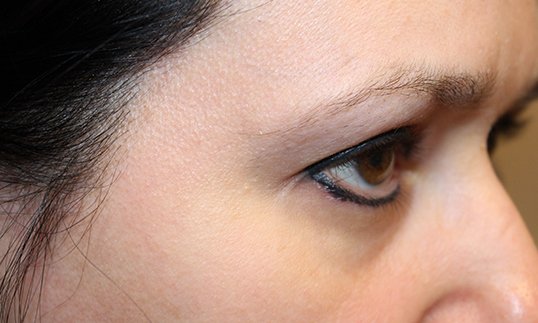 brow lift on young female patient before