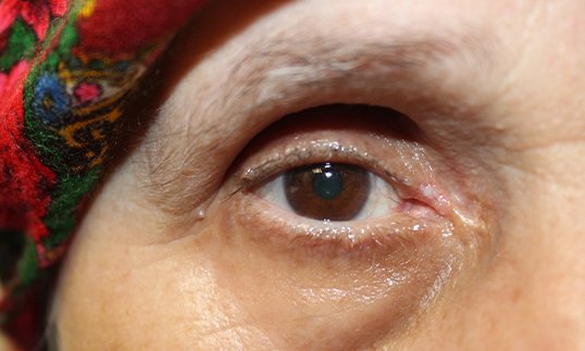eyelid reconstruction for cancer results