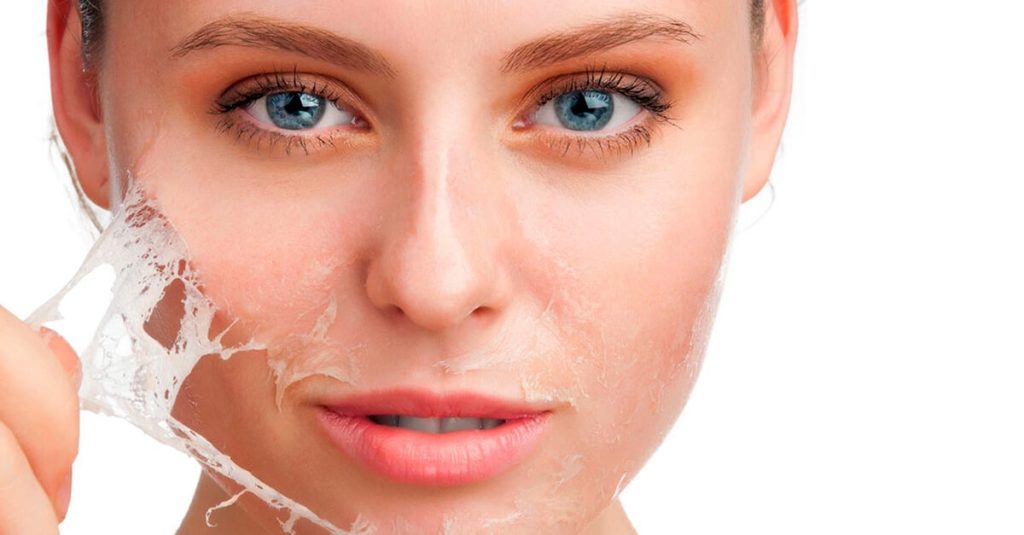 chemical face peel