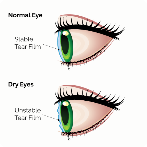 Diagram comparing a stable tear film to an unstable tear film because of dry eye