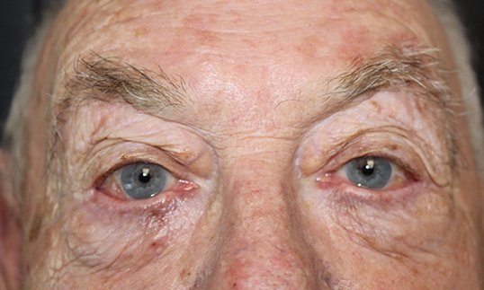 entropion repair on males eyes results
