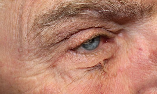 entropion repair on male eye before the procedure