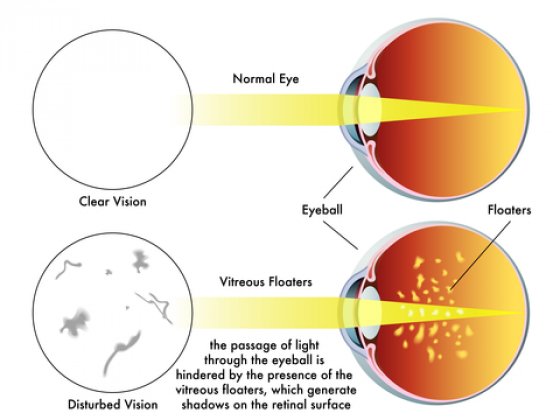 eye floaters diagram