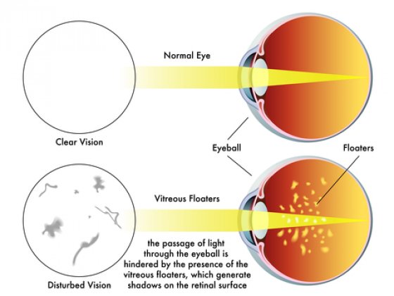 Black Spot in the Eyes - Eye Floaters - Centre For Sight