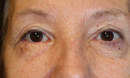 eyelid reconstruction after cancer on females eye