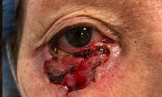 eyelid reconstruction for cancer before the surgery