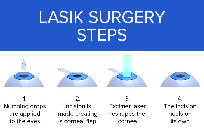 lasik surgery steps infographic