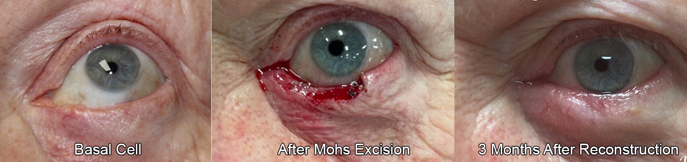 before and after MOHS excision on patient