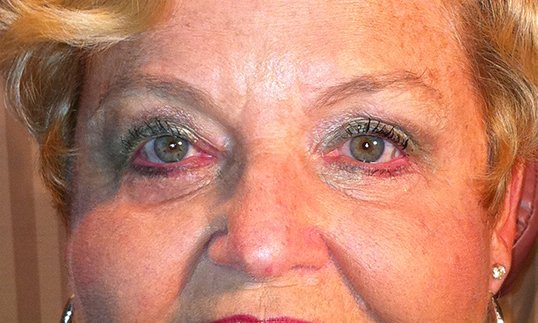 blepharoplasty surgery results older woman looking straight ahead
