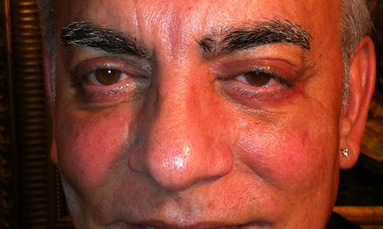 middle aged man looking straight into the camera after blepharoplasty surgery
