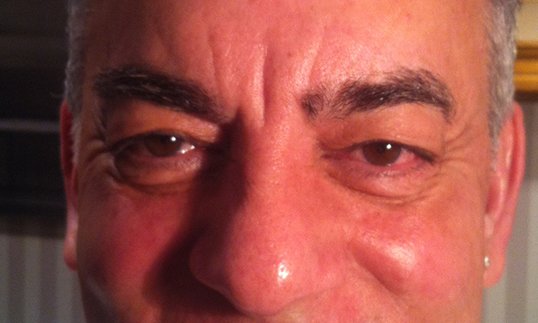middle aged male patient before lower blepharoplasty surgery